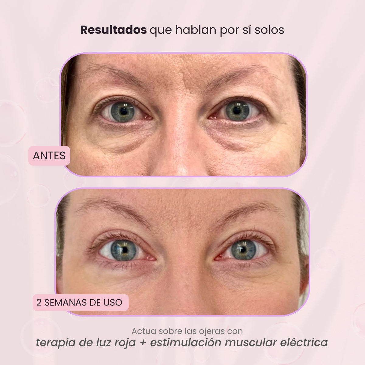 RevitalEyes® 2 en 1: terapia de luz roja + EMS para eliminar las bolsas de los ojos