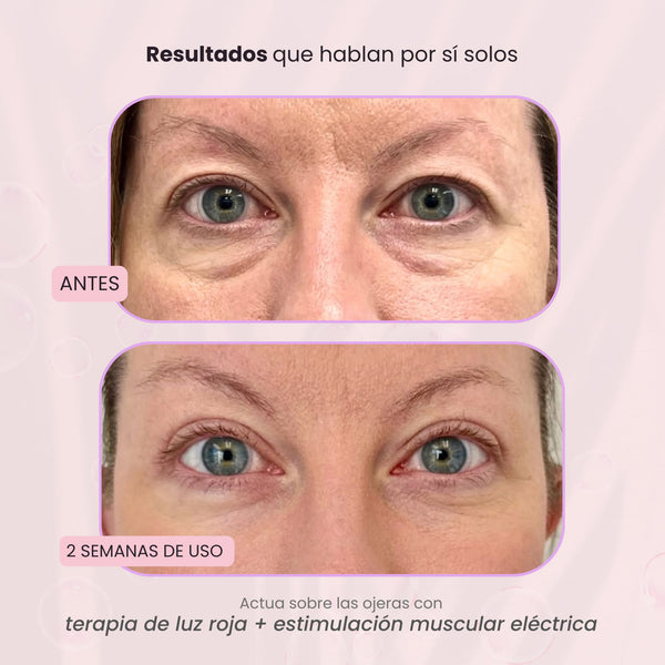 RevitalEyes® 2 en 1: terapia de luz roja + EMS para eliminar las bolsas de los ojos