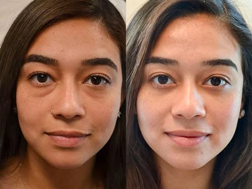  — resultado antes y después